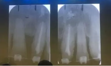 【聽課筆記】拔牙后位點的軟硬組織處理 【聽課筆記】拔牙后位點的軟硬組織處理