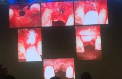 【聽課筆記】拔牙后位點的軟硬組織處理 【聽課筆記】拔牙后位點的軟硬組織處理