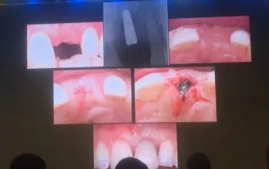 【聽課筆記】拔牙后位點的軟硬組織處理 【聽課筆記】拔牙后位點的軟硬組織處理