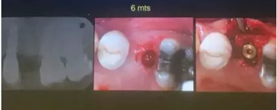 【聽課筆記】拔牙后位點的軟硬組織處理 【聽課筆記】拔牙后位點的軟硬組織處理