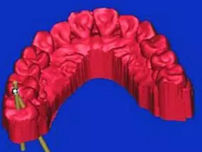 神奇的口腔「3D」 革命 神奇的口腔「3D」 革命