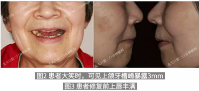 病例報(bào)道│全程數(shù)字化輔助無牙頜種植即刻負(fù)重 病例報(bào)道│全程數(shù)字化輔助無牙頜種植即刻負(fù)重