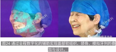 病例報(bào)道│全程數(shù)字化輔助無牙頜種植即刻負(fù)重 病例報(bào)道│全程數(shù)字化輔助無牙頜種植即刻負(fù)重