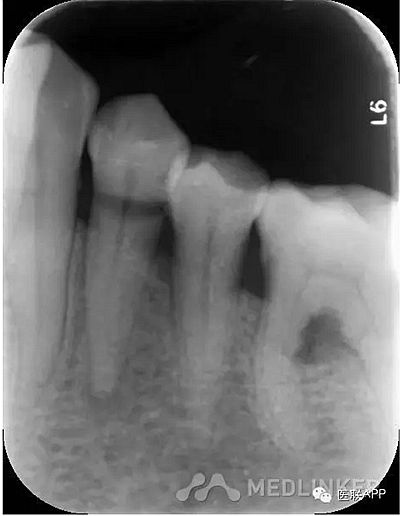 楔狀缺損導致根尖周炎 楔狀缺損導致根尖周炎