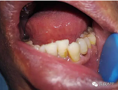 楔狀缺損導致根尖周炎 楔狀缺損導致根尖周炎