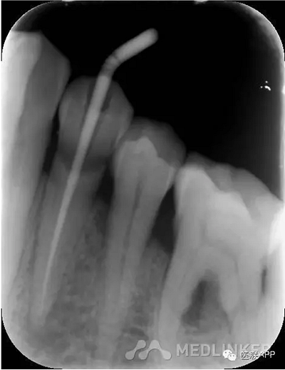 楔狀缺損導致根尖周炎 楔狀缺損導致根尖周炎