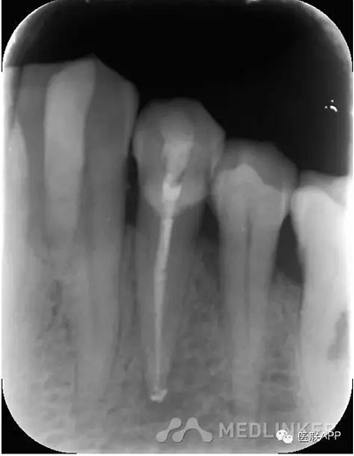 楔狀缺損導致根尖周炎 楔狀缺損導致根尖周炎
