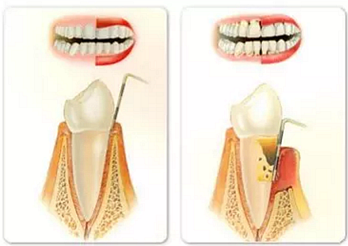 上海嘉?？谇谎芯克皇兰o(jì)牙周病的臨床進(jìn)展