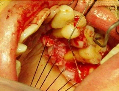 上海嘉?？谇谎芯克皇兰o(jì)牙周病的臨床進(jìn)展