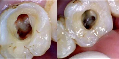 上海嘉?？谇谎芯克皇兰o(jì)根管治療的進(jìn)展