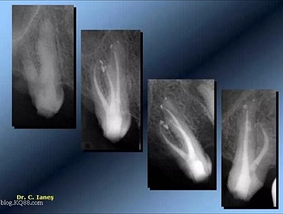 上海嘉?？谇谎芯克皇兰o(jì)根管治療的進(jìn)展