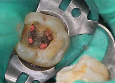 .上海嘉?？谇谎芯克皇兰o(jì)根管治療的進(jìn)展