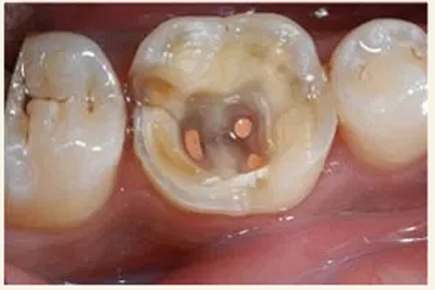 上海嘉?？谇谎芯克皇兰o(jì)根管治療的進(jìn)展