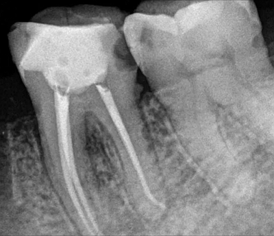 上海嘉福口腔研究所二十一世紀(jì)根管治療的進(jìn)展