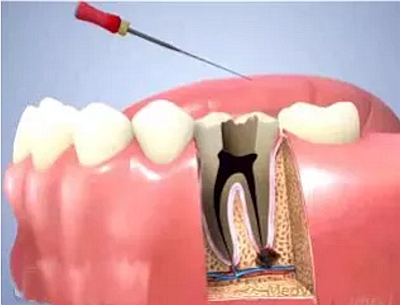 上海嘉?？谇谎芯克皇兰o(jì)根管治療的進(jìn)展