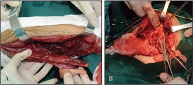 下頜骨腓骨移植聯(lián)合牙種植術(shù)后的覆蓋義齒修復(fù)1例 下頜骨腓骨移植聯(lián)合牙種植術(shù)后的覆蓋義齒修復(fù)1例