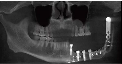 下頜骨腓骨移植聯(lián)合牙種植術(shù)后的覆蓋義齒修復(fù)1例 下頜骨腓骨移植聯(lián)合牙種植術(shù)后的覆蓋義齒修復(fù)1例