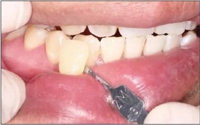 下頜骨腓骨移植聯(lián)合牙種植術(shù)后的覆蓋義齒修復(fù)1例 下頜骨腓骨移植聯(lián)合牙種植術(shù)后的覆蓋義齒修復(fù)1例