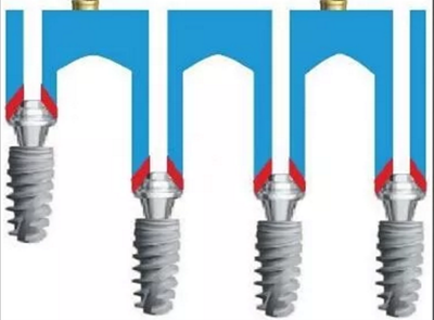 下頜骨腓骨移植聯(lián)合牙種植術(shù)后的覆蓋義齒修復(fù)1例 下頜骨腓骨移植聯(lián)合牙種植術(shù)后的覆蓋義齒修復(fù)1例