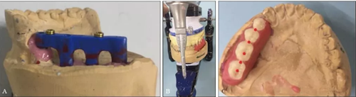 下頜骨腓骨移植聯(lián)合牙種植術(shù)后的覆蓋義齒修復(fù)1例 下頜骨腓骨移植聯(lián)合牙種植術(shù)后的覆蓋義齒修復(fù)1例