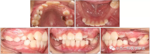 右下頜第一磨牙遠中水平阻生1例 右下頜第一磨牙遠中水平阻生1例