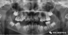右下頜第一磨牙遠中水平阻生1例 右下頜第一磨牙遠中水平阻生1例