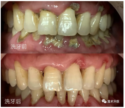 牙周炎，中國成年人后半生永遠的 痛 ！