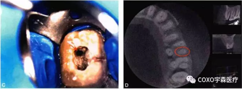 (六期)細(xì)小鈣化根管的疏通——病因及診斷 (六期)細(xì)小鈣化根管的疏通——病因及診斷