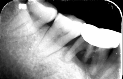 病例分享|下頜后牙牙槽嵴保存延期種植頰側(cè)骨壁吸收植骨引導(dǎo)骨再生一例 病例分享|下頜后牙牙槽嵴保存延期種植頰側(cè)骨壁吸收植骨引導(dǎo)骨再生一例
