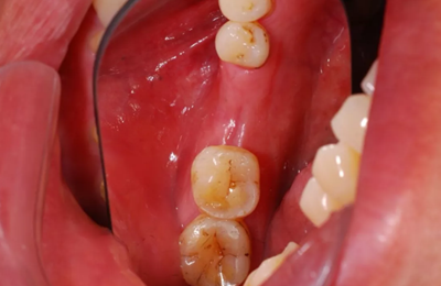 病例分享|下頜后牙牙槽嵴保存延期種植頰側(cè)骨壁吸收植骨引導(dǎo)骨再生一例 病例分享|下頜后牙牙槽嵴保存延期種植頰側(cè)骨壁吸收植骨引導(dǎo)骨再生一例