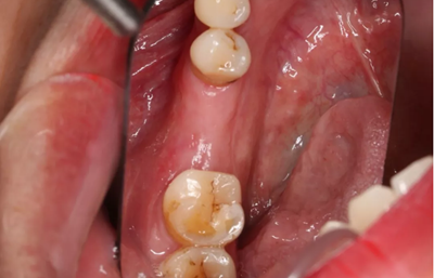 病例分享|下頜后牙牙槽嵴保存延期種植頰側(cè)骨壁吸收植骨引導(dǎo)骨再生一例 病例分享|下頜后牙牙槽嵴保存延期種植頰側(cè)骨壁吸收植骨引導(dǎo)骨再生一例