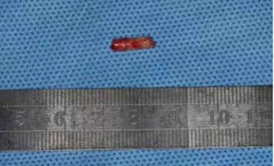 病例分享|下頜后牙牙槽嵴保存延期種植頰側(cè)骨壁吸收植骨引導(dǎo)骨再生一例 病例分享|下頜后牙牙槽嵴保存延期種植頰側(cè)骨壁吸收植骨引導(dǎo)骨再生一例