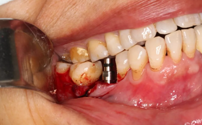 病例分享|下頜后牙牙槽嵴保存延期種植頰側(cè)骨壁吸收植骨引導(dǎo)骨再生一例 病例分享|下頜后牙牙槽嵴保存延期種植頰側(cè)骨壁吸收植骨引導(dǎo)骨再生一例