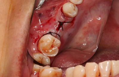 病例分享|下頜后牙牙槽嵴保存延期種植頰側(cè)骨壁吸收植骨引導(dǎo)骨再生一例 病例分享|下頜后牙牙槽嵴保存延期種植頰側(cè)骨壁吸收植骨引導(dǎo)骨再生一例