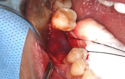 病例分享|下頜后牙牙槽嵴保存延期種植頰側(cè)骨壁吸收植骨引導(dǎo)骨再生一例 病例分享|下頜后牙牙槽嵴保存延期種植頰側(cè)骨壁吸收植骨引導(dǎo)骨再生一例
