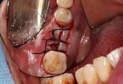 病例分享|下頜后牙牙槽嵴保存延期種植頰側(cè)骨壁吸收植骨引導(dǎo)骨再生一例 病例分享|下頜后牙牙槽嵴保存延期種植頰側(cè)骨壁吸收植骨引導(dǎo)骨再生一例
