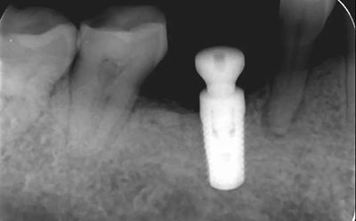 病例分享|下頜后牙牙槽嵴保存延期種植頰側(cè)骨壁吸收植骨引導(dǎo)骨再生一例 病例分享|下頜后牙牙槽嵴保存延期種植頰側(cè)骨壁吸收植骨引導(dǎo)骨再生一例