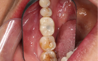 病例分享|下頜后牙牙槽嵴保存延期種植頰側(cè)骨壁吸收植骨引導(dǎo)骨再生一例 病例分享|下頜后牙牙槽嵴保存延期種植頰側(cè)骨壁吸收植骨引導(dǎo)骨再生一例