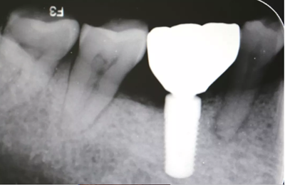 病例分享|下頜后牙牙槽嵴保存延期種植頰側(cè)骨壁吸收植骨引導(dǎo)骨再生一例 病例分享|下頜后牙牙槽嵴保存延期種植頰側(cè)骨壁吸收植骨引導(dǎo)骨再生一例