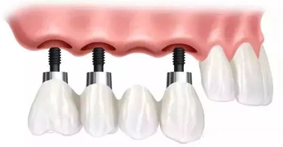 延長(zhǎng)種植牙使用壽命的方法 延長(zhǎng)種植牙使用壽命的方法