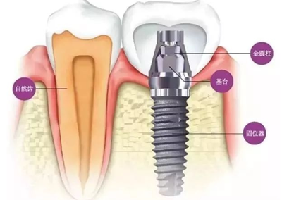 延長(zhǎng)種植牙使用壽命的方法 延長(zhǎng)種植牙使用壽命的方法