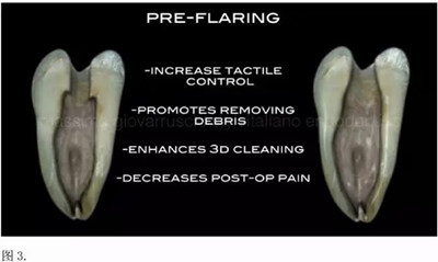 【病例分享】根管冠部預敞 【病例分享】根管冠部預敞