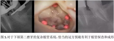 【病例分享】根管冠部預敞 【病例分享】根管冠部預敞