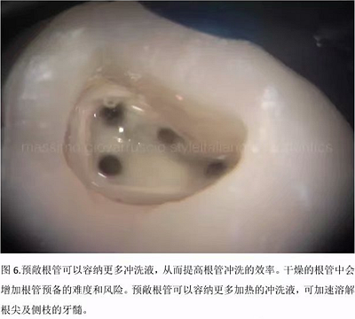 【病例分享】根管冠部預敞 【病例分享】根管冠部預敞