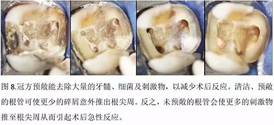 【病例分享】根管冠部預敞 【病例分享】根管冠部預敞