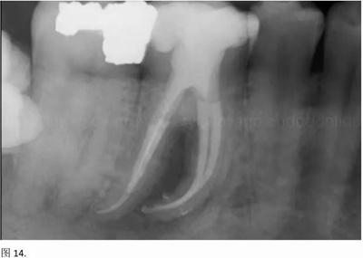 【病例分享】根管冠部預敞 【病例分享】根管冠部預敞