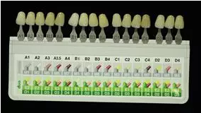 病例分享｜復合樹脂微創(chuàng)美學修復關閉上前牙間隙