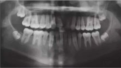 【病例分享】上頜中切牙區(qū)外傷的自體移植和正畸治療 【病例分享】上頜中切牙區(qū)外傷的自體移植和正畸治療