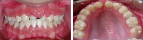 【病例分享】上頜中切牙區(qū)外傷的自體移植和正畸治療 【病例分享】上頜中切牙區(qū)外傷的自體移植和正畸治療