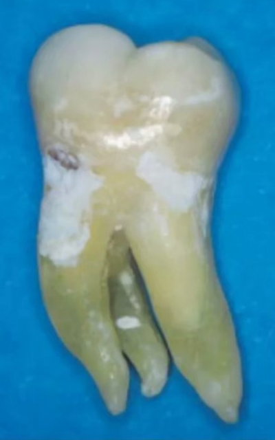 宇森SC-Pro鎳鈦根管銼|宇森醫(yī)療根管治療器械領(lǐng)跑者 宇森SC-Pro鎳鈦根管銼|宇森醫(yī)療根管治療器械領(lǐng)跑者